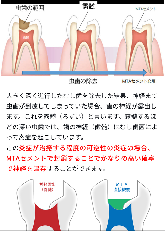 MTA